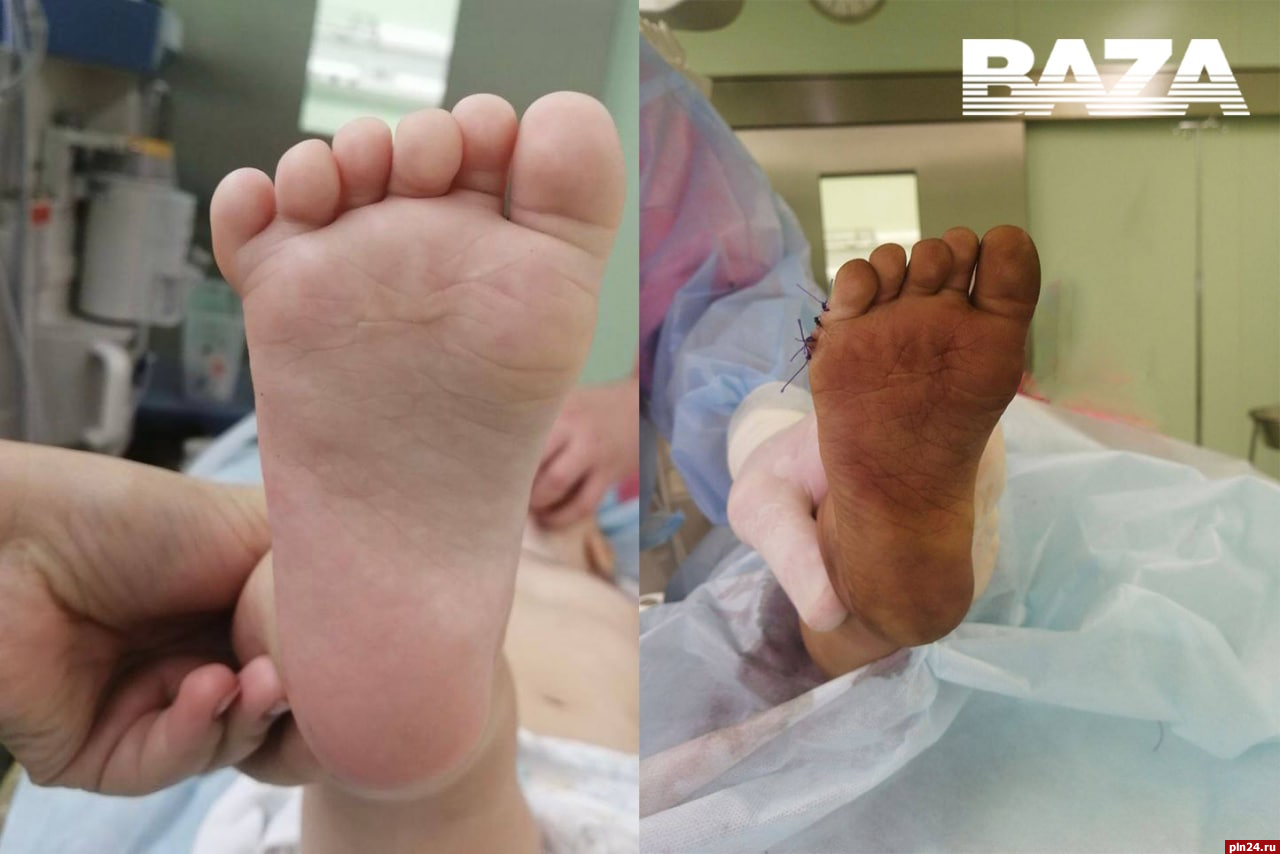 Российские травматологи удалили шестой палец на ноге ребёнка